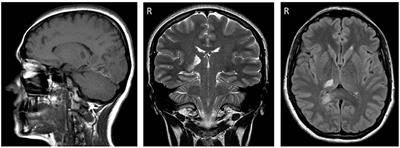 Efficacy of Repetitive Transcranial Magnetic Stimulation for Acute Central Post-stroke Pain: A Case Study